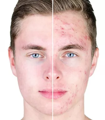 Trattamento per le Cicatrici dell'Acne | Estetica Cerbone