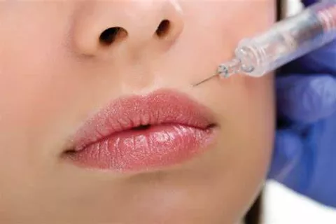 Trattamento Filler - Estetica Cerbone