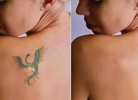 Rimozione Tatuaggi Professionale | Estetica Cerbone