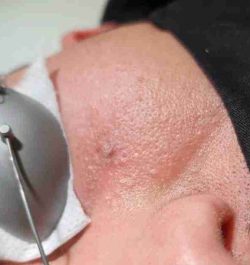 angioma stellato dopo